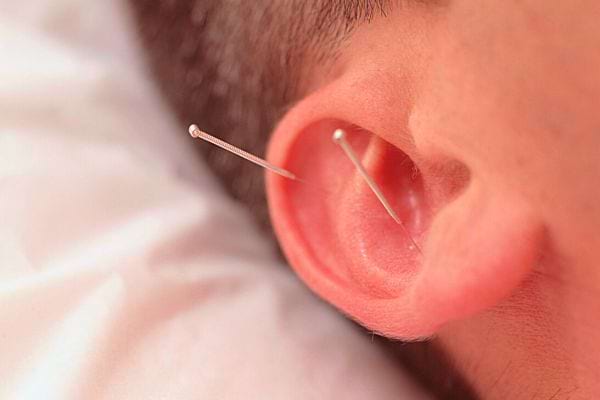 Gros plan d'une aiguille d'acupuncture insérée dans l'oreille d'un patient.