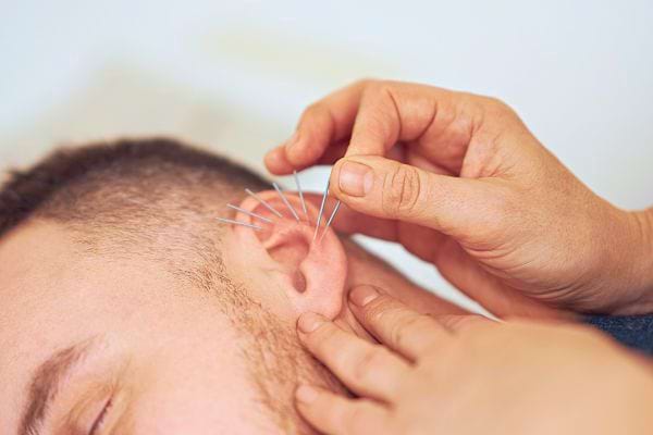 Plusieurs aiguilles d'acupuncture en position sur l'oreille d'un patient allongé.