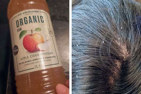 Vinaigre de cidre pour les soins capillaires : Bouteille de vinaigre de cidre organique à côté de cheveux avec pellicules.