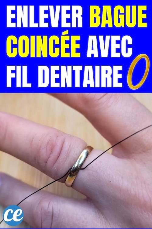 Enlever Bague Coincée avec Fil Dentaire