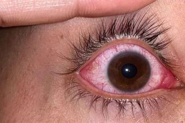 Gros plan sur un œil rougi et qui semble piquer.
