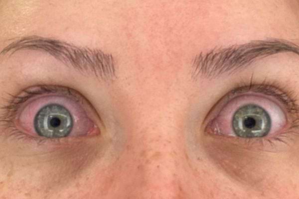 Une femme aux yeux rouges, ouverts et irrités.