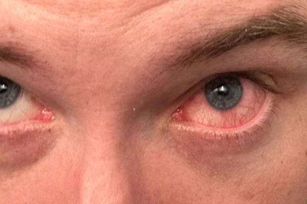 Un homme aux yeux rouges et irrités.