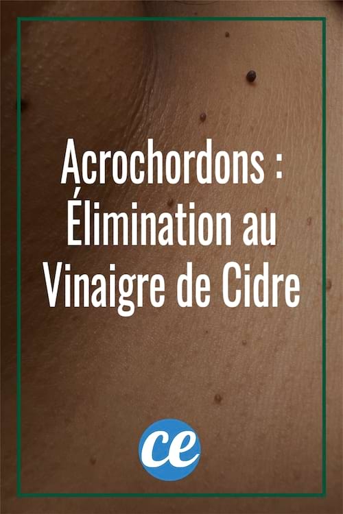 Acrochordons Comment Les Faire Disparaître avec du Vinaigre de Cidre.