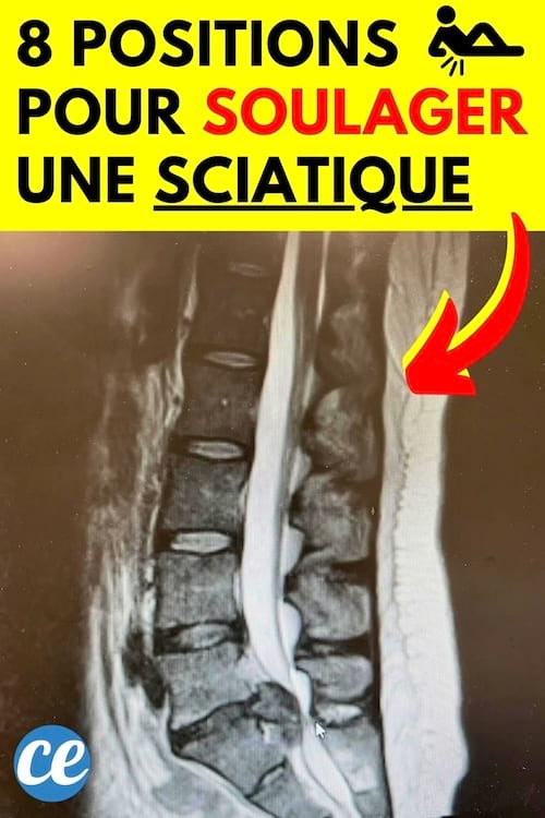 Photo radio sciatique 