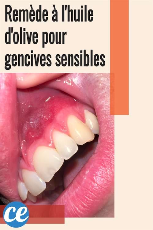 Des gencives sensibles avec dents