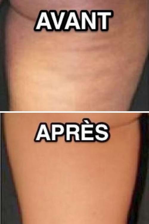 Cellulite de cuisse avant après