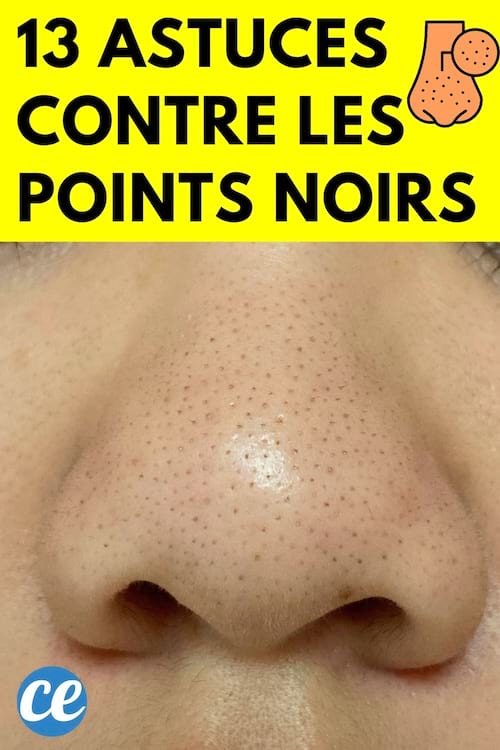 Un nez remplie de points noirs