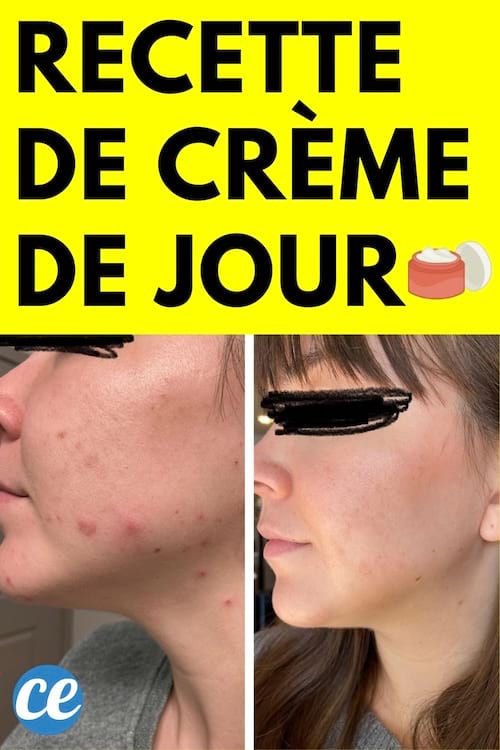 Avant après visage femme avec et sans boutons 