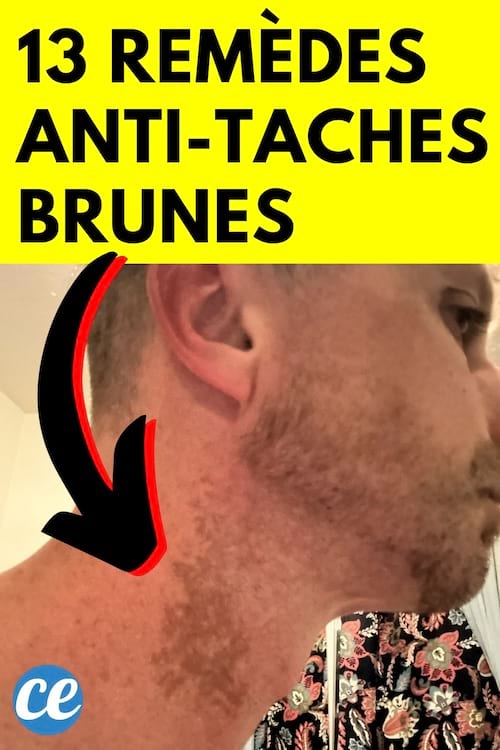 Taches brune sur cou homme