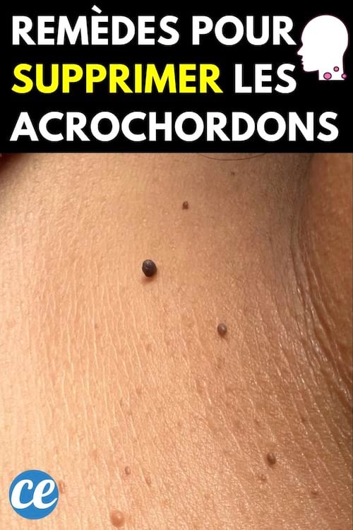 Acrochordons sur cou