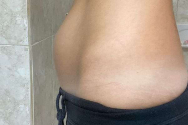 Un ventre ballonné vu de profil.