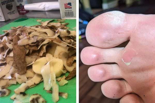 Épluchures de pomme de terre et ampoule au pied.