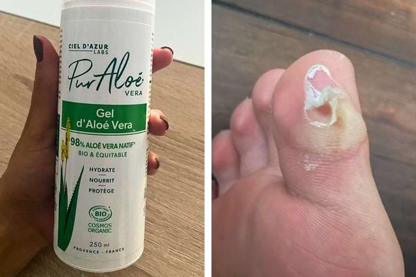 Gel d'aloe vera et ampoule sur le pied.