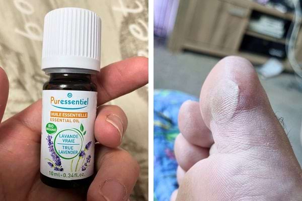 Huile essentielle de lavande et pied avec ampoule.