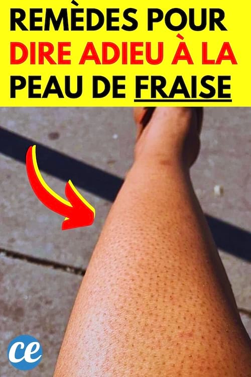 Une jambe avec la peau de fraise et comment s'en débarrasser au naturel