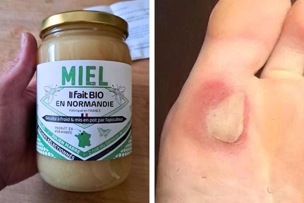 Pot de miel et ampoule au pied.