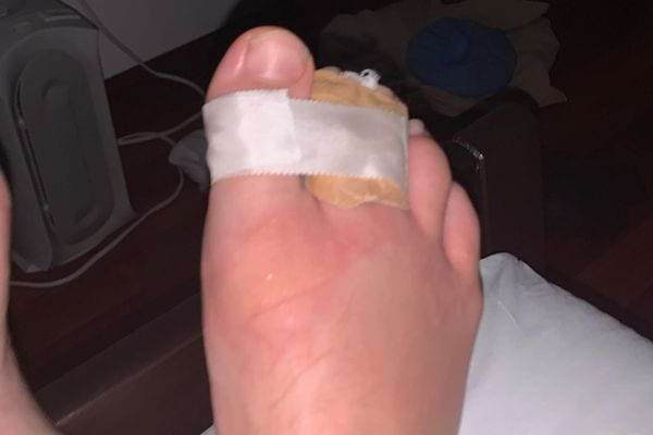 Pied avec pansement sur l'ampoule.