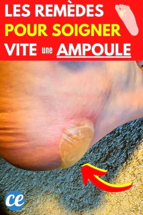 Une grosse ampoule sous le pied qui a gonflé et pleine de liquide
