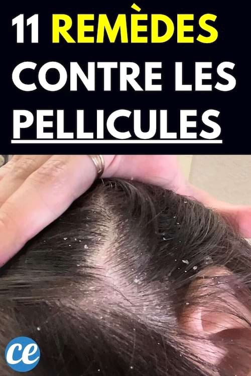 pellicules dans cheveux 