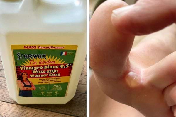 Vinaigre blanc et ampoule entre les orteils.