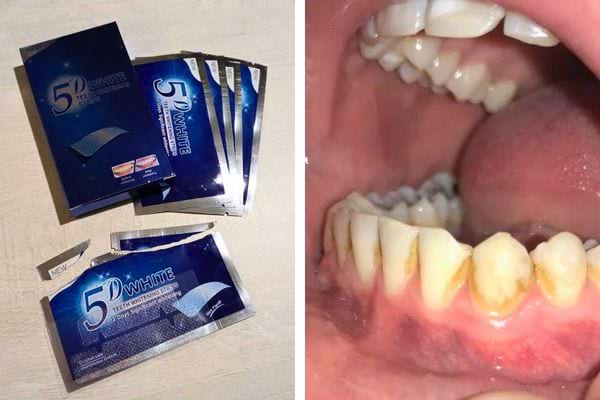Paquet ouvert de bandes blanchissantes pour les dents exposées.