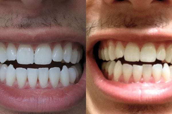 Deux images comparant les sourires d'une personne avant et après blanchiment.