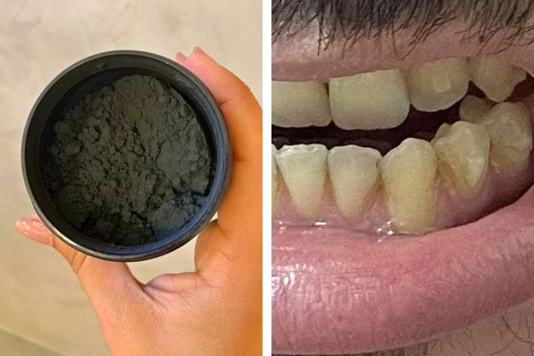 Comparaison des dents avant et après l'utilisation de dentifrice au charbon actif.