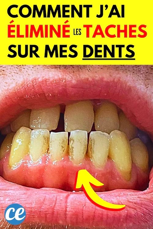 Des taches blanches sur mes dents que j'ai réussi à faire disparaître au naturel