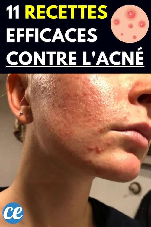 De l'acné sur le visage d'une personne