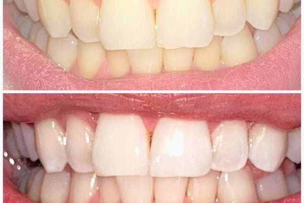 Un sourire éclatant montrant les dents après un traitement de blanchiment.