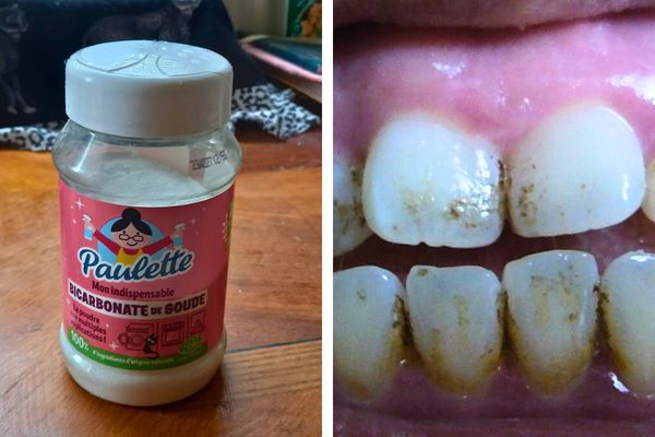 La Meilleure Astuce pour Éliminer les Taches sur les Dents.