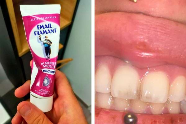 Une personne tenant un tube de dentifrice pour blanchiment des dents.