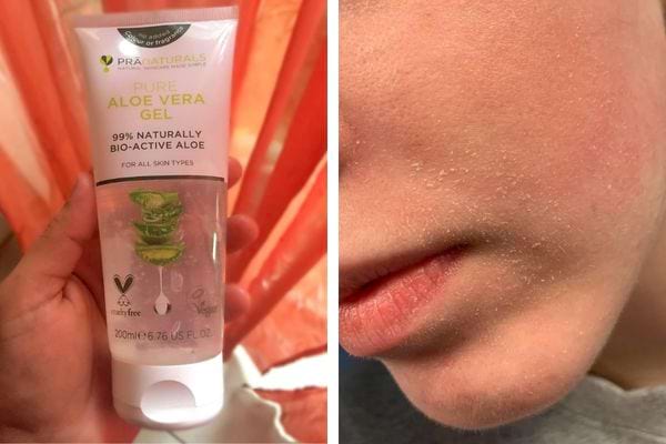 Gel aloe vera et menton sec et irrité.