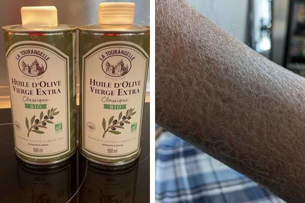 Bouteille d'huile d'olive et bras avec peau sèche.