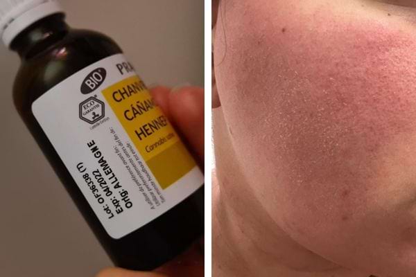 Bouteille d'huile de chanvre et joue sèche et rouge.