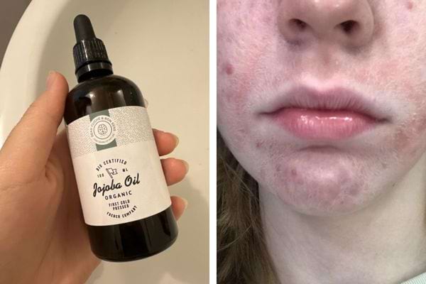 Huile de jojoba et visage avec acné.