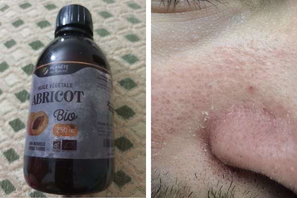 Bouteille d'huile d'abricot et peau irritée près du nez.
