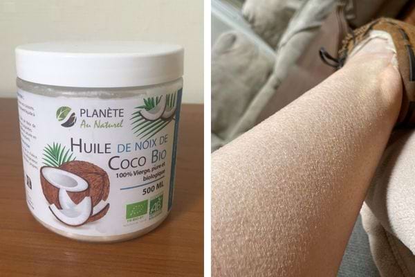 Pot d'huile de noix de coco et jambe très sèche.
