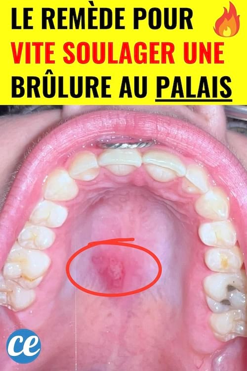 Une brûlure sur le palais de la bouche qui va être soigné avec des remèdes