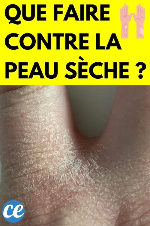 De la sécheresse sur une main 