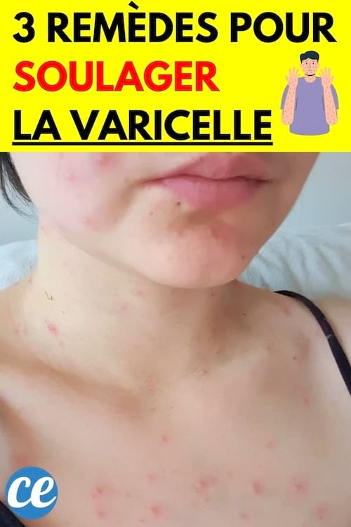 Une femme avec la varicelle