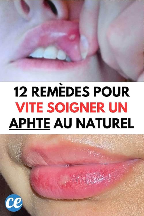 1 aphte sur la lèvre qui a besoin d'être soigné au naturel