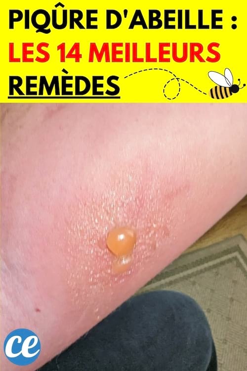 Une grosse piqûre d'abeille