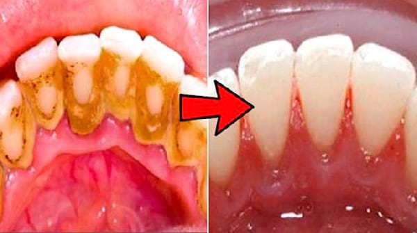 3 Astuces Étonnantes Pour Détartrer Ses Dents Facilement à la Maison