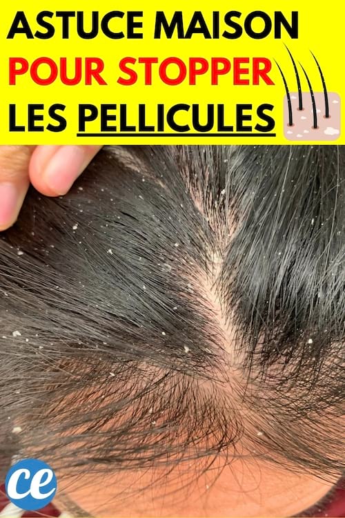 Personne tenant ses cheveux remplis de pellicules capillaires