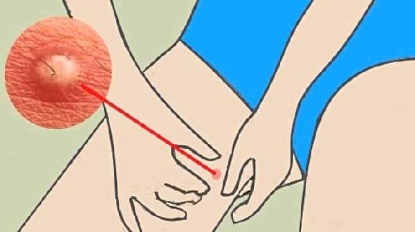 Comment Se Débarrasser des Furoncles entre les Cuisses (Ces Boutons Durs et Douloureux)