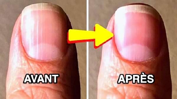 Ongles Striés dans la Longueur : Quelles Sont les Causes de Ces Traits  Et Que Faire Pour Y Remédier