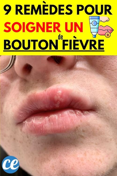 Un bouton de fièvre sur une lèvre 