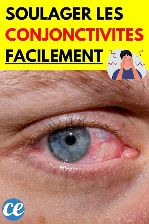 Un œil irrité et rouge dû à une conjonctivite